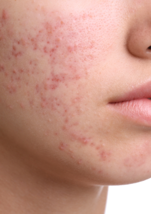 Prescriptive Acne Treatment